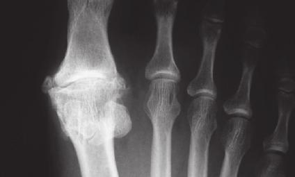 Mõnikord on väljendunud artroosi esmaseks tunnuseks kõnnimustri muutumine või suutmatus tõusta varvastele, kuna varvas