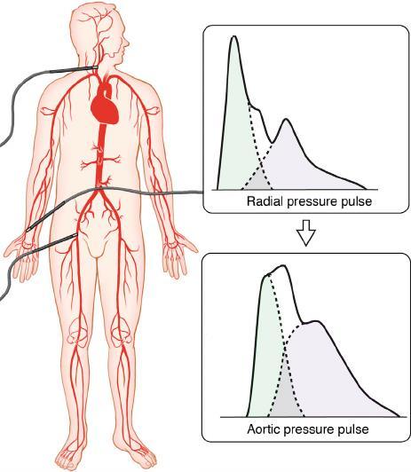 Figure 7 a schematic representation of the clinical gold-standard pulse-wave velocity (PWV) measurement in the carotid-femoral region [18] For this method to work small current is applied to the site