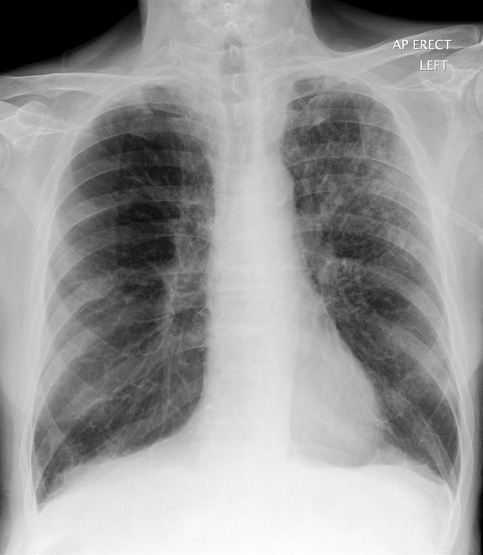 199 Rindkeremeditsiin Joon. 4.19 AP-suunaline rindkere röntgenülesvõte, millel on näha vasaku ülavälja õhuruumide varjustus. Kuigi nii näeb tihti välja infektsioon, on leid mittespetsiifiline.