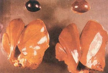 Tüüfuse lahanguleid Pruunikas suurenenud maks, kus kärbunud koldeid või abstsesse