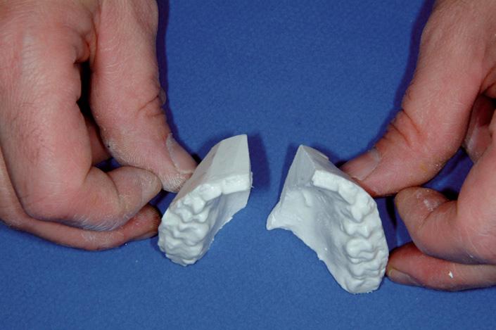 L examen de profil aidera à déterminer quel est le côté hypertrophié ou au contraire atrophique. Ces asymétries mandibulaires se comportent comme des prognathies ou rétrognathies unilatérales.