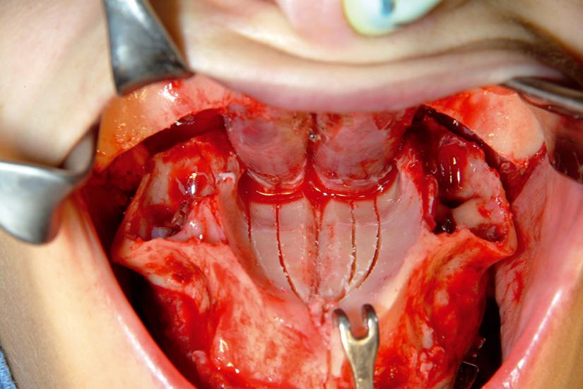 164 Orthod Fr 2011;82:159 169 Figure 6 Expansion maxillaire. Figure 8 Disjonction inter-maxillaire chirurgicale pré-orthodontique double asymétrique.