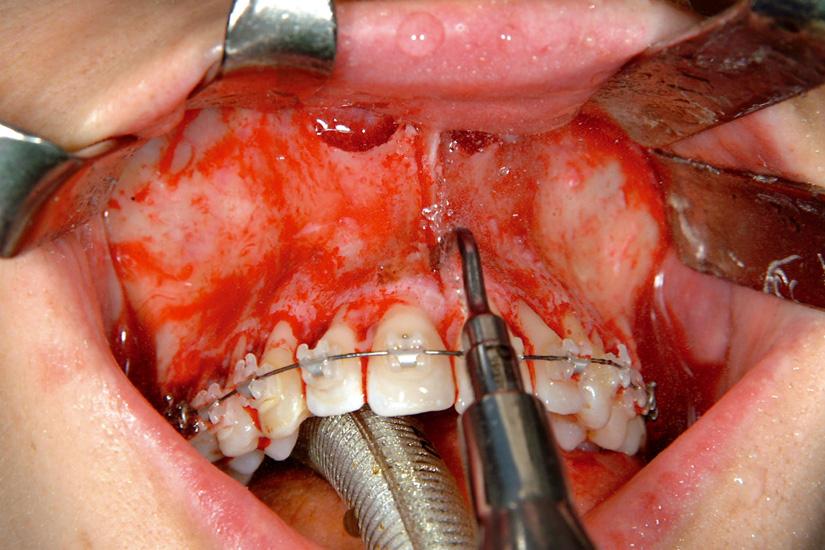 La disjonction inter-maxillaire chirurgicale pré-orthodontique Elle consiste à réouvrir chirurgicalement la suture inter-maxillaire ossifiée chez l adulte pour pouvoir réaliser une expansion