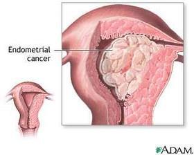 Endomeetriumi vähk 80% histoloogiline leid adenokartsinoom Valikmarker puudub.