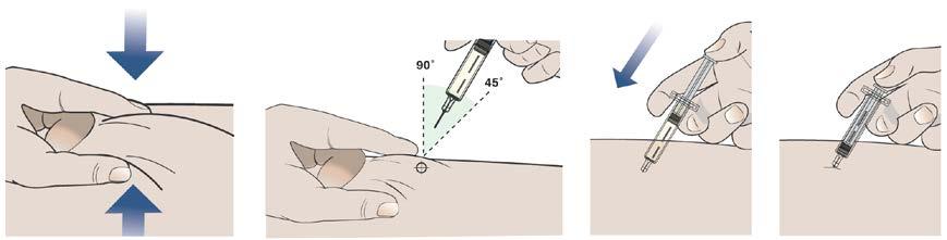 c) Tõmmake nõel nahast välja. Pärast kogu ravimi süstimist tõmmake nõel otse välja. Vigastuste ja nakkuste vältimiseks ei tohi nõelakatet süstlile tagasi panna. d) Suruge kergelt süstekohale.
