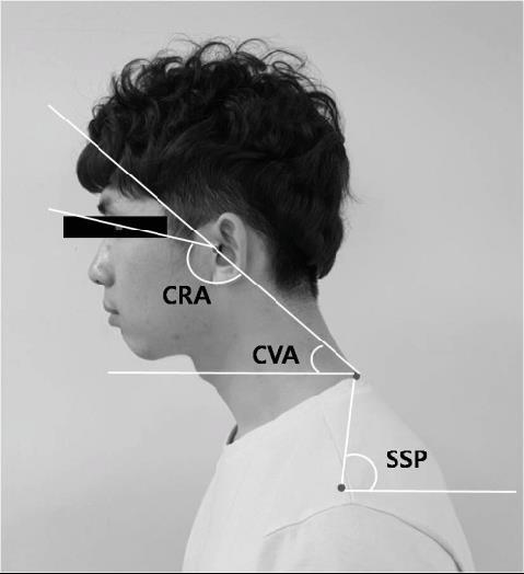 väiksema lülisamba kraniovertebraalnurgaga uuritavatel esineb pea eesasend, müofastsiaalsed pea- ja kaelavalud ning väiksem kaelaosa liikuvusulatus kui sümptomivabadel uuritavatel (Jung et al, 2016).