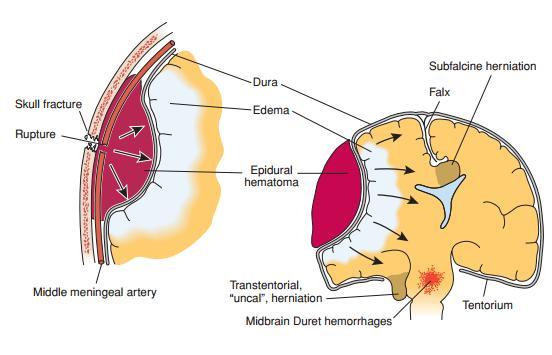1.2.2. Epidural hematoma Epidural hematoma happens when patient bleeds into the epidural space due to detachment of the outer dural sheath from the skull and rupture of a meningeal artery Epidural