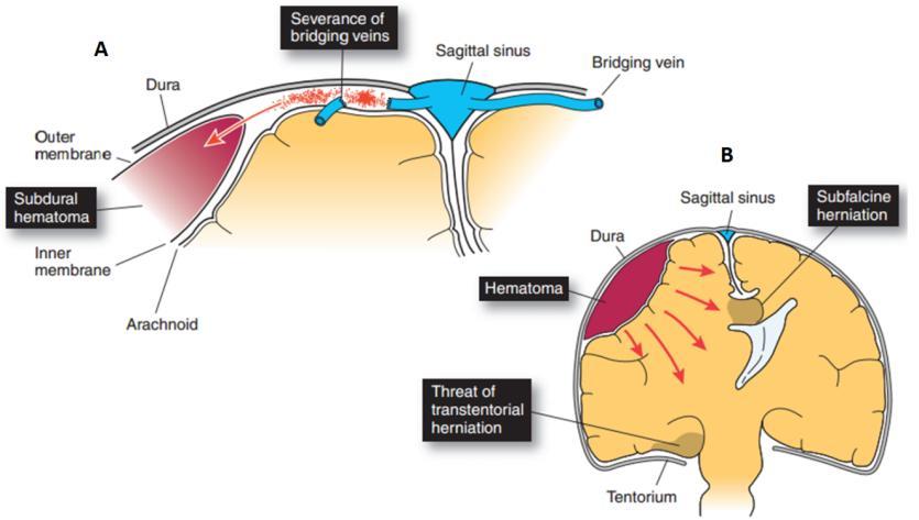 In the figure above we can see a laceration of a branch of the middle meningeal artery by the sharp bony edges of a skull fracture initiates bleeding under arterial pressure that dissects the dura