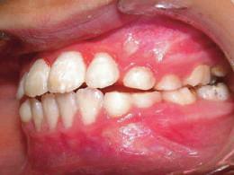 L effet ingressif des secteurs latéraux peut être augmenté sur les dents de six ans, par ajout de résine, tandis que les meulages des dents de lait diminuent la hauteur de l occlusion.