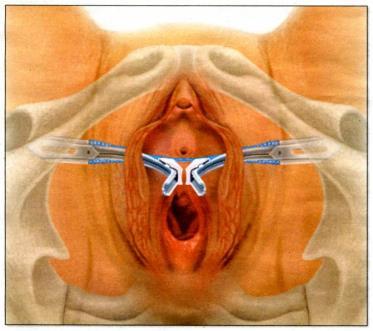 (praeputium et frenulum clitoridis) Ostium urethrae