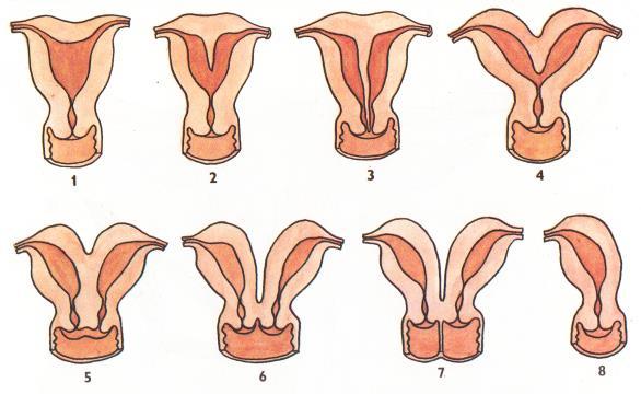 septus uterus bipartitus