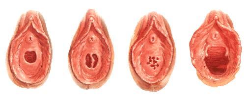 Ostium vaginae (vestibulum vaginae) 43 44 Ostium urethrae ext.