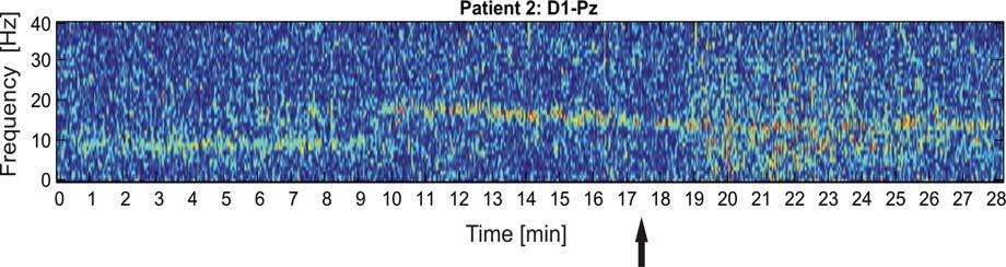 Rida katsete seeriaid on näidanud, et mikrolainekiirgus kui inimese poolt otseselt mittetunnetetav mõjur (mikrolainekiirguse sensor inimesel puudub) tekitab EEG signaali nivoos muutusi, mis on