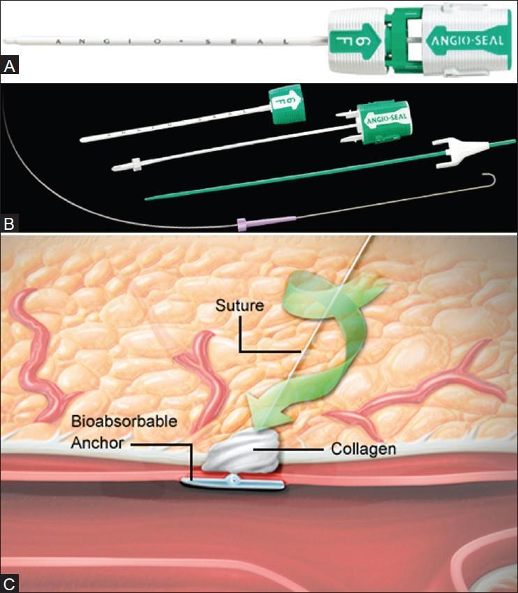 AngioSeal sulgur Veresoone sulgemise meetod, kus kollageen fikseeritakse arteri välispinnale. AngioSeal seade on valmistatud kolmest absorbeeruvast komponendist: väike ankur, kollageen ja õmblusniit.