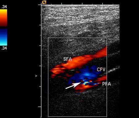 Arterio-venoosne fistel Teavita arsti Võib vajada ultraheliga juhitud