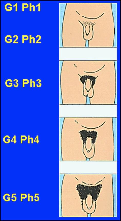 Laste endokrinoloogil Objektivselt: Tüüpilise fenotüübiga Puberteet: G3 (testsed sin=6 ml; dex=6) Pu4, Ax3 Mõõdukas tõeline günekomasta Kasv 172,4 (90ts),kaal 58,7(90ts), vanemate keskmine pikkus