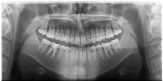 2.2.4 ISIK III-3 1991. aastal sündinud noormehel puudub sünnipäraselt ainult üks hammas (Pilt 8 ja 9). Juure asendi järgi võib eeldada, et tegemist on hambaga 41. Pilt 8.