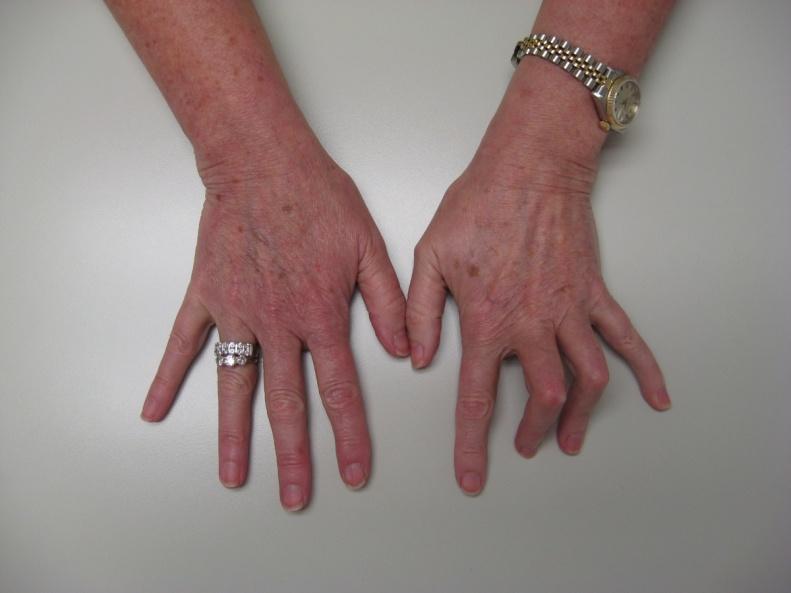 Vasaku käe III ja IV sõrmel