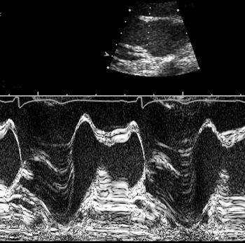 ülenev,alanev aort,ulatub diafragmani - III b ainult
